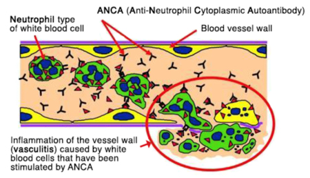 ANCA-induced activation of neutrophils