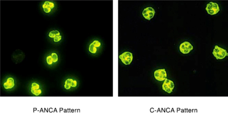 Indirect immunofluorescence of ANCA