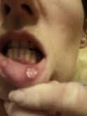 Behcets mouth ulcers