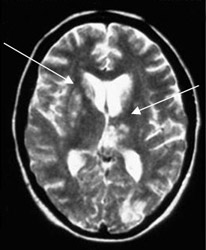 Primary cerebral vasculitis