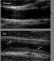 Dopper Ultrasound