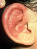 Swelling of the ear