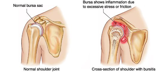 Illustrations showing normal shoulder joint and inflammation of shoulder joint