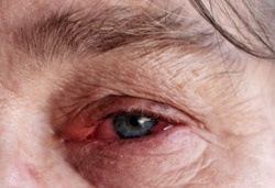 Rheumatoid Arthritis red eye