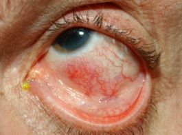 Scleritis in a patient with WG