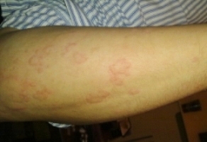 UV stinging nettle rash