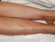 Vasculitis leg rash