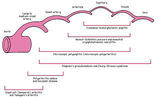 kawasaki arteritis