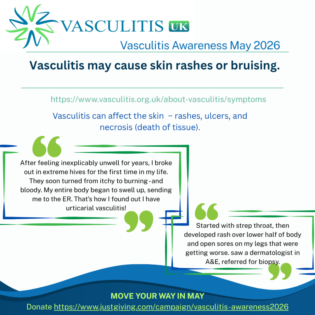 Vasculitis can affect the skin – rashes, ulcers, and necrosis (death of tissue).